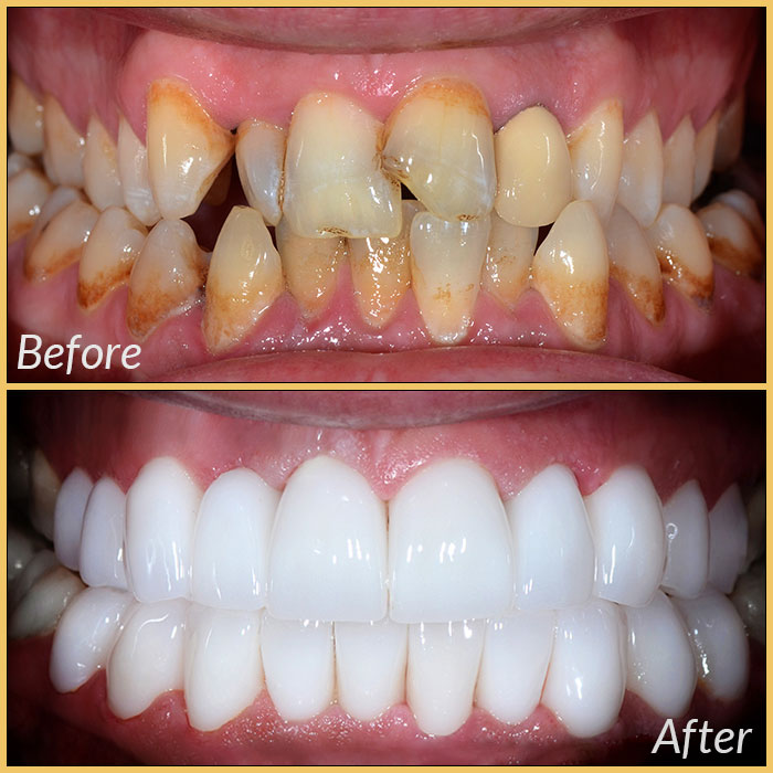 emax laminate veneers