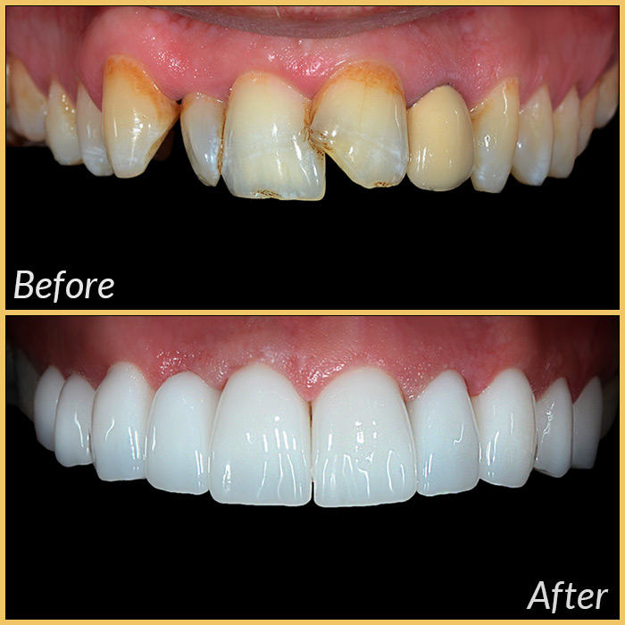emax laminate veneers