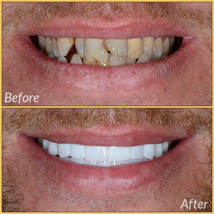 emax laminate veneers