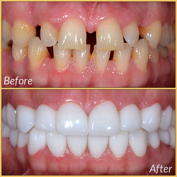 emax laminate veneers