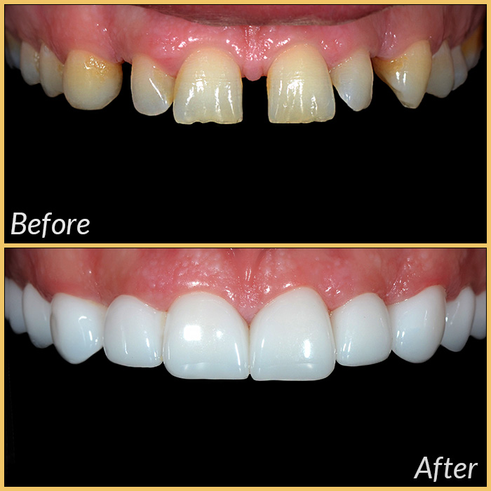emax laminate veneers