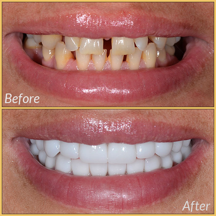 emax laminate veneers
