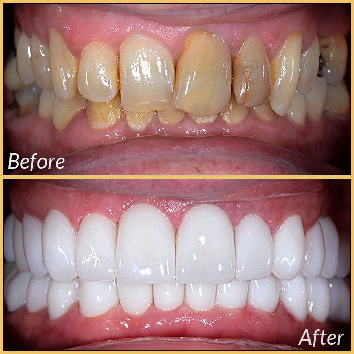 emax laminate veneers