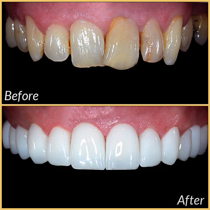emax laminate veneers