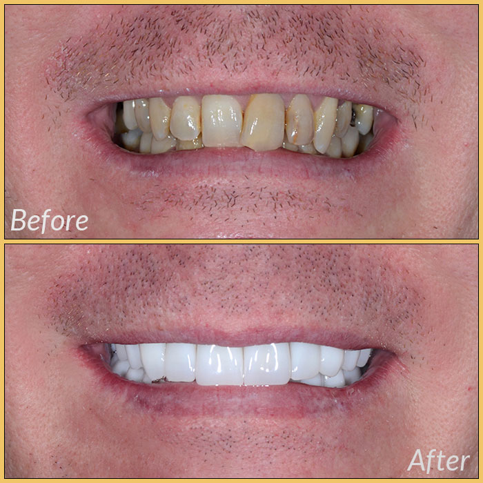 emax laminate veneers