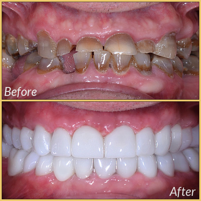 emax laminate veneers