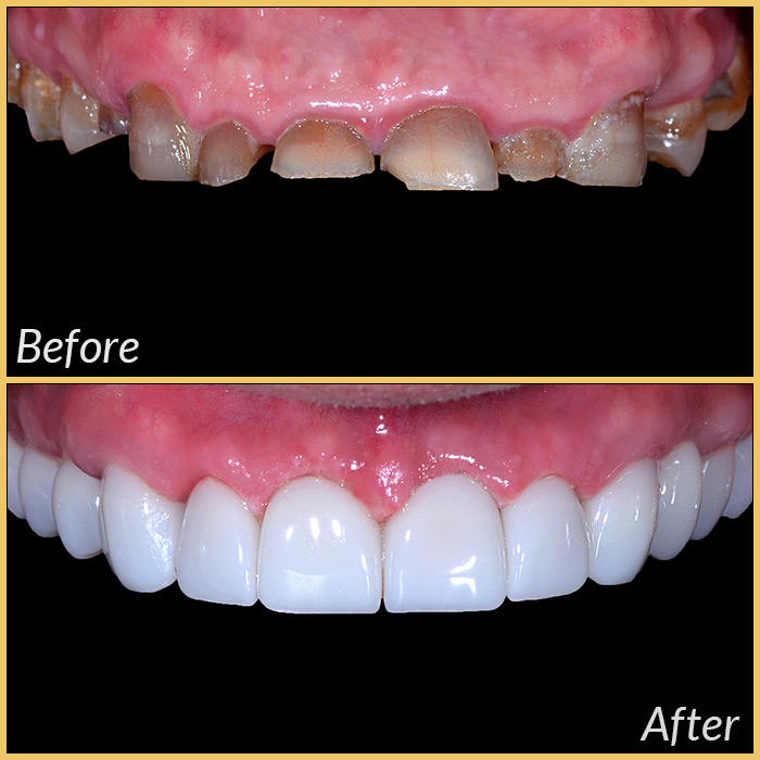 emax laminate veneers