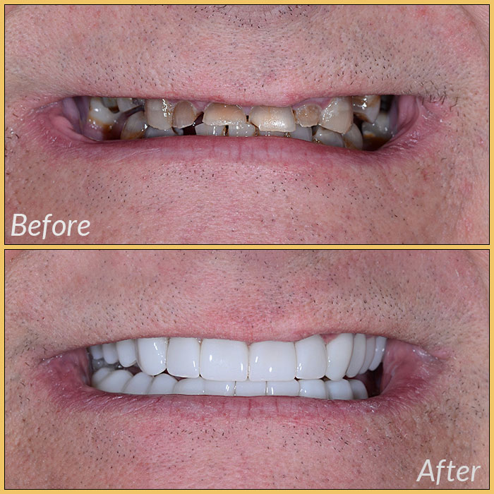 emax laminate veneers