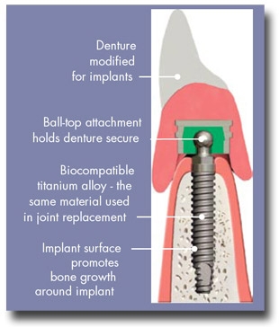 Ball Attachment