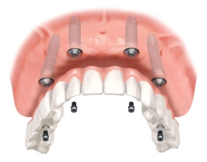 Overdenture Locator