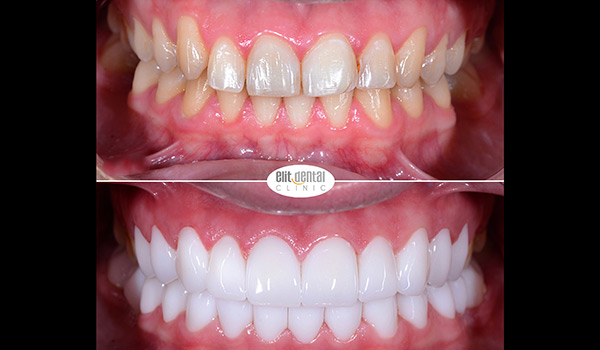 veneered zirconia crown