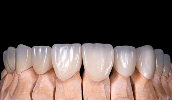 monolithic zirconia crown