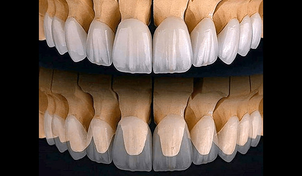 turkey zirconia crown